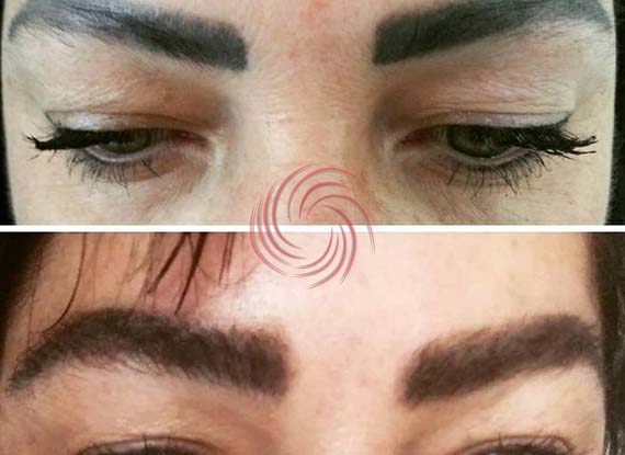 eyebrow transplant before and after 1