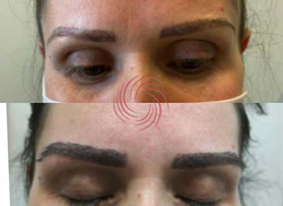 eyebrow transplant before and after 5